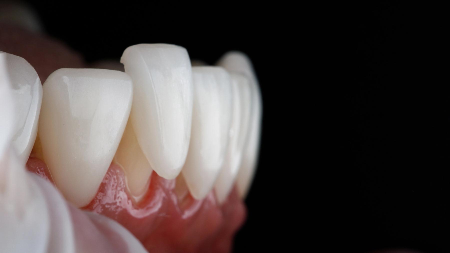 Image Alt a close up of a person 's teeth with a black background .