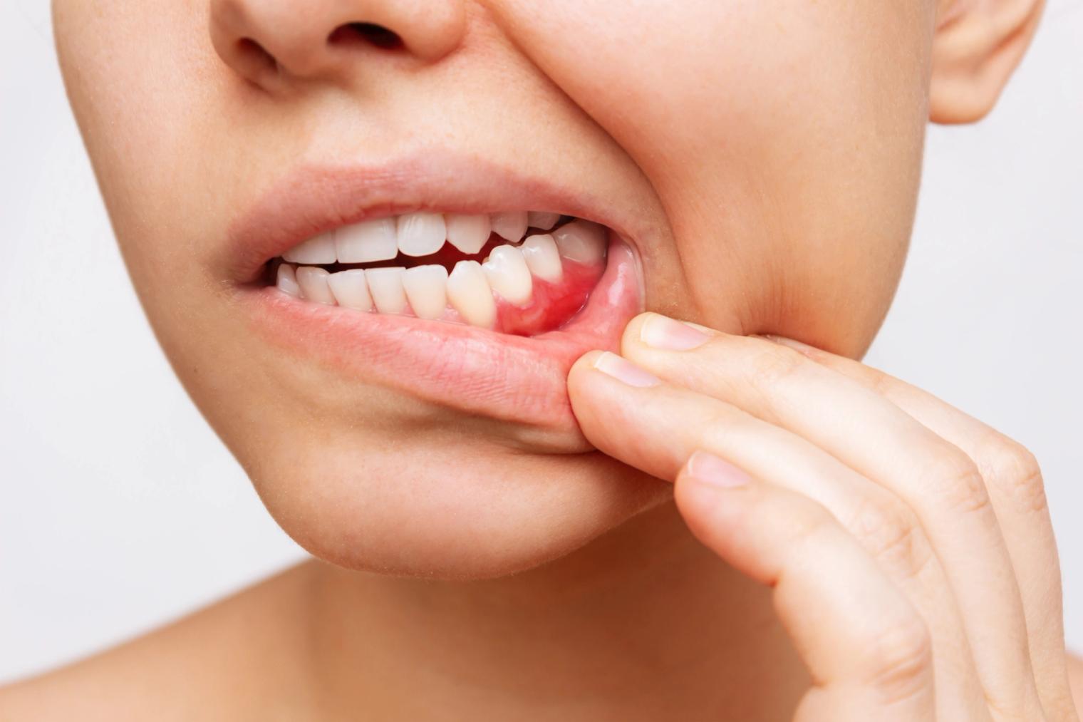 A person pulls down their lower lip to reveal inflamed, red gums around a tooth.
