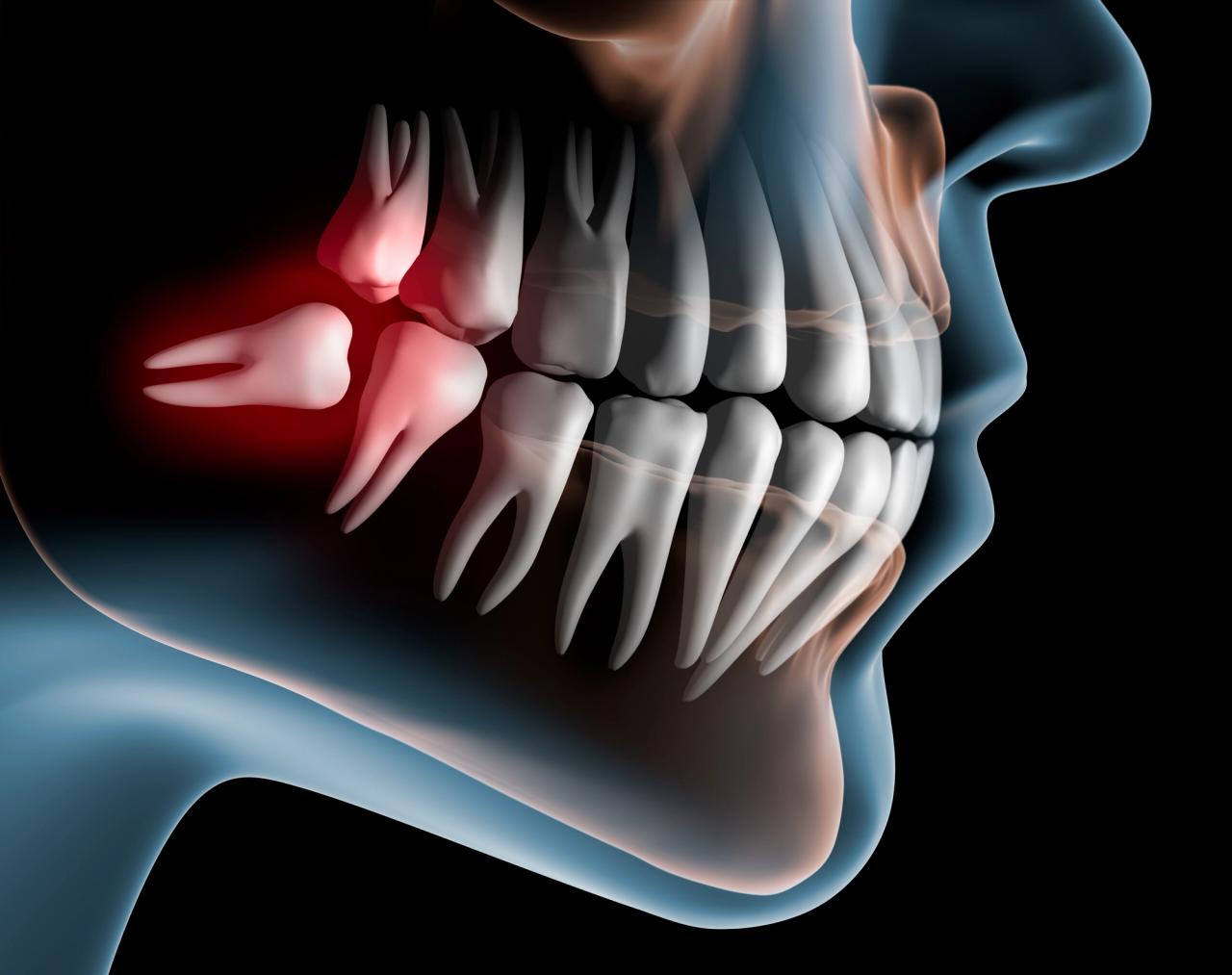 3D medical illustration of a human jaw with painful wisdom teeth highlighted in red.